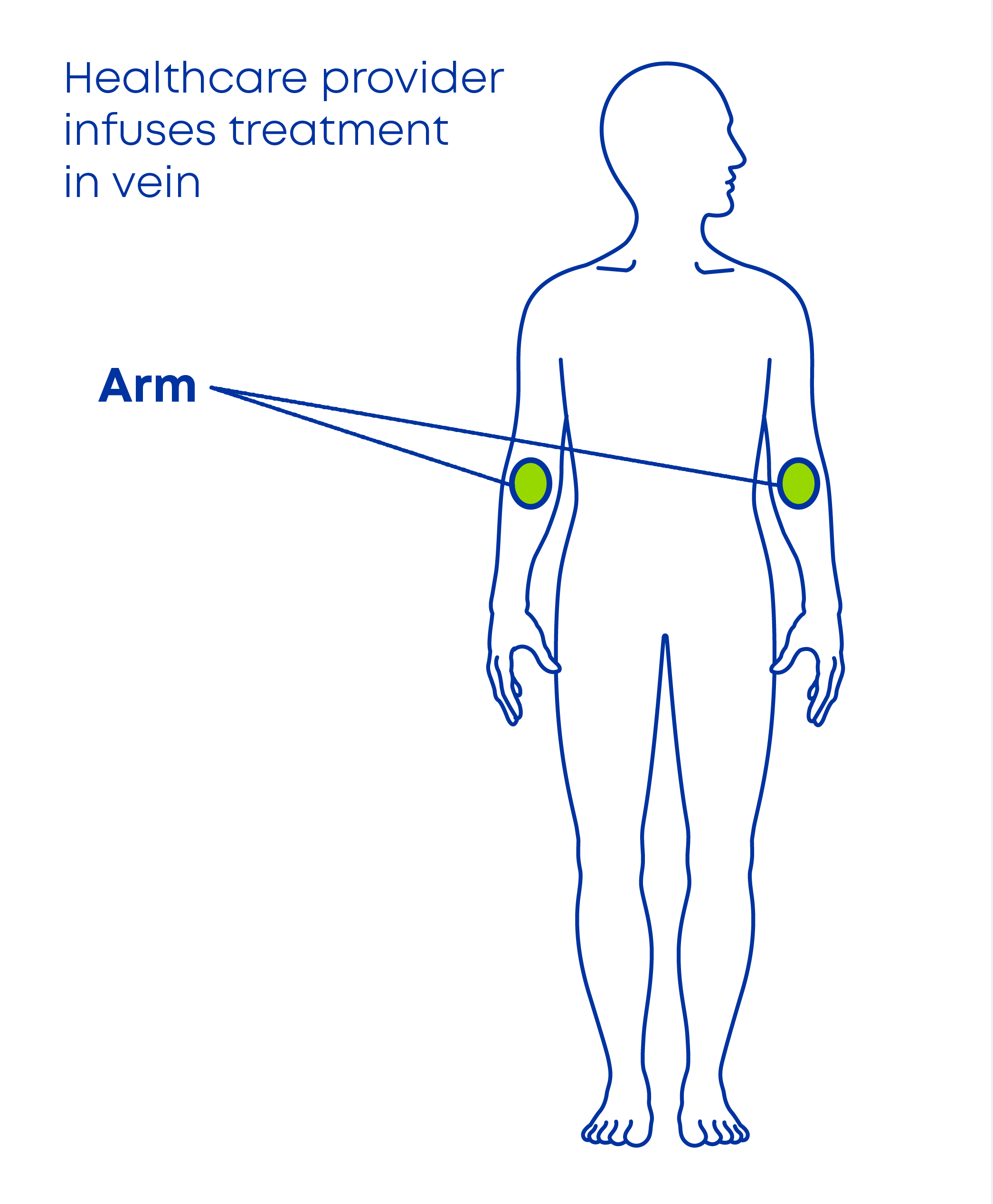Diagram of human body with infusion sites indicated at inside elbow of both arms.